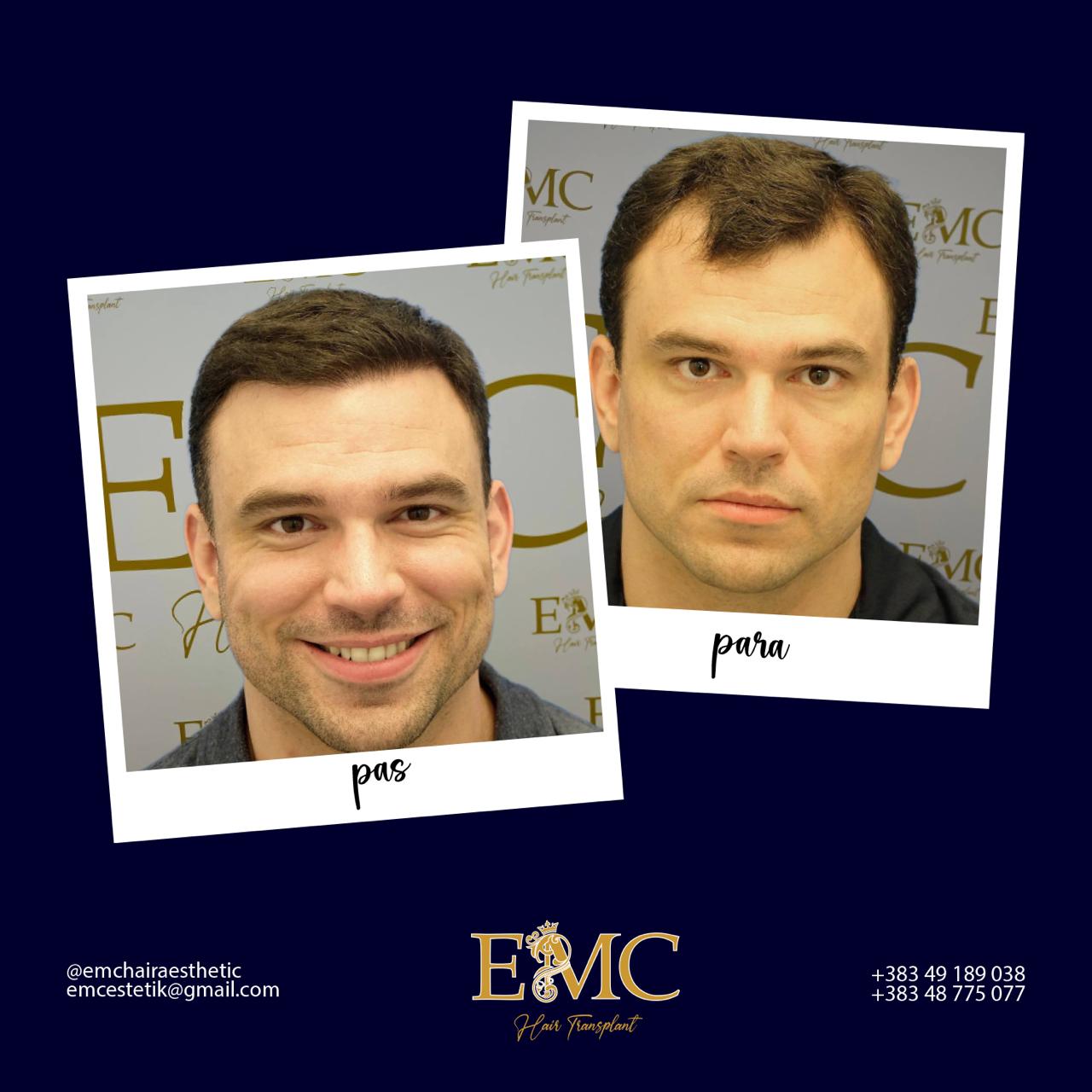 Before & After Hair Transplant Result 4