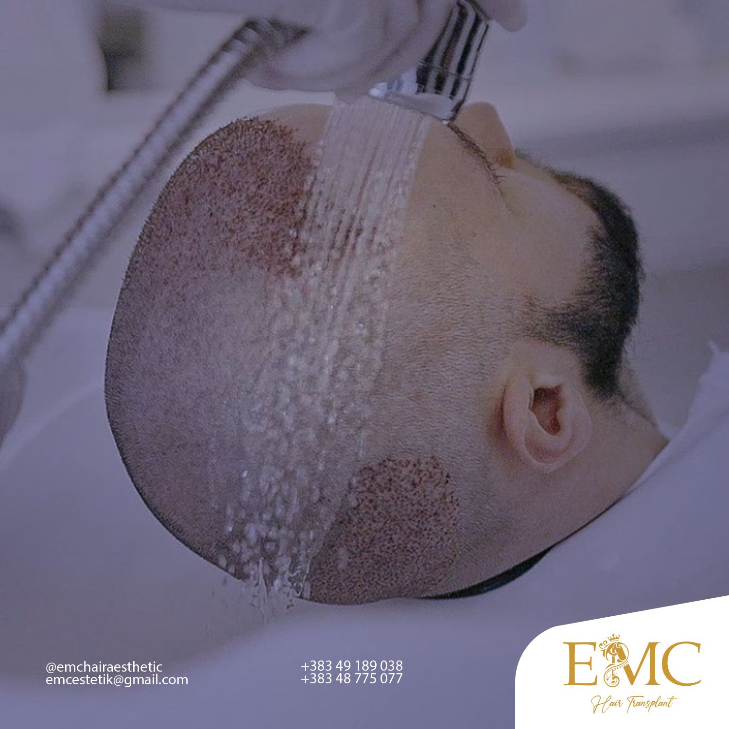 Stem Cell Therapy