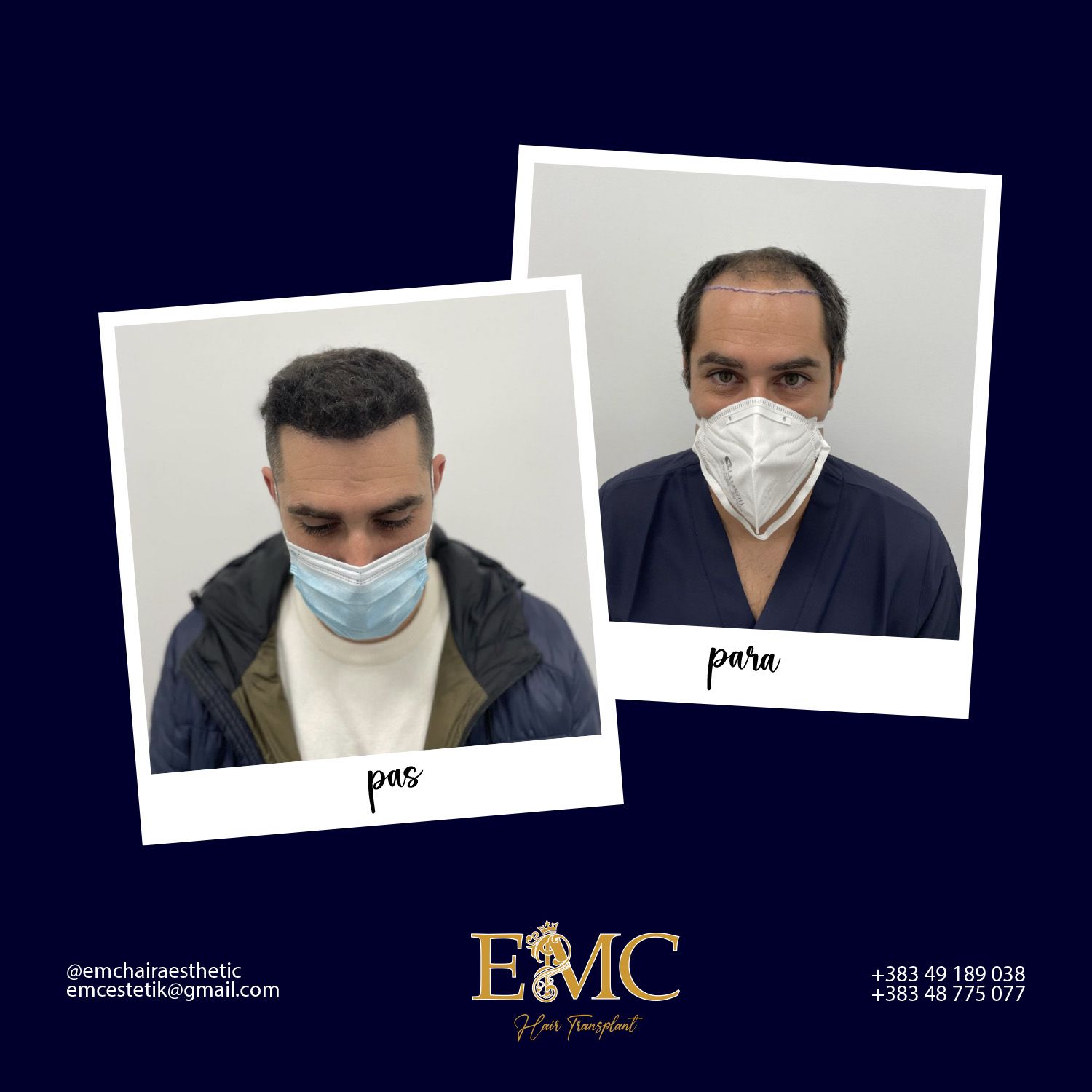 Before & After Hair Transplant Result 2