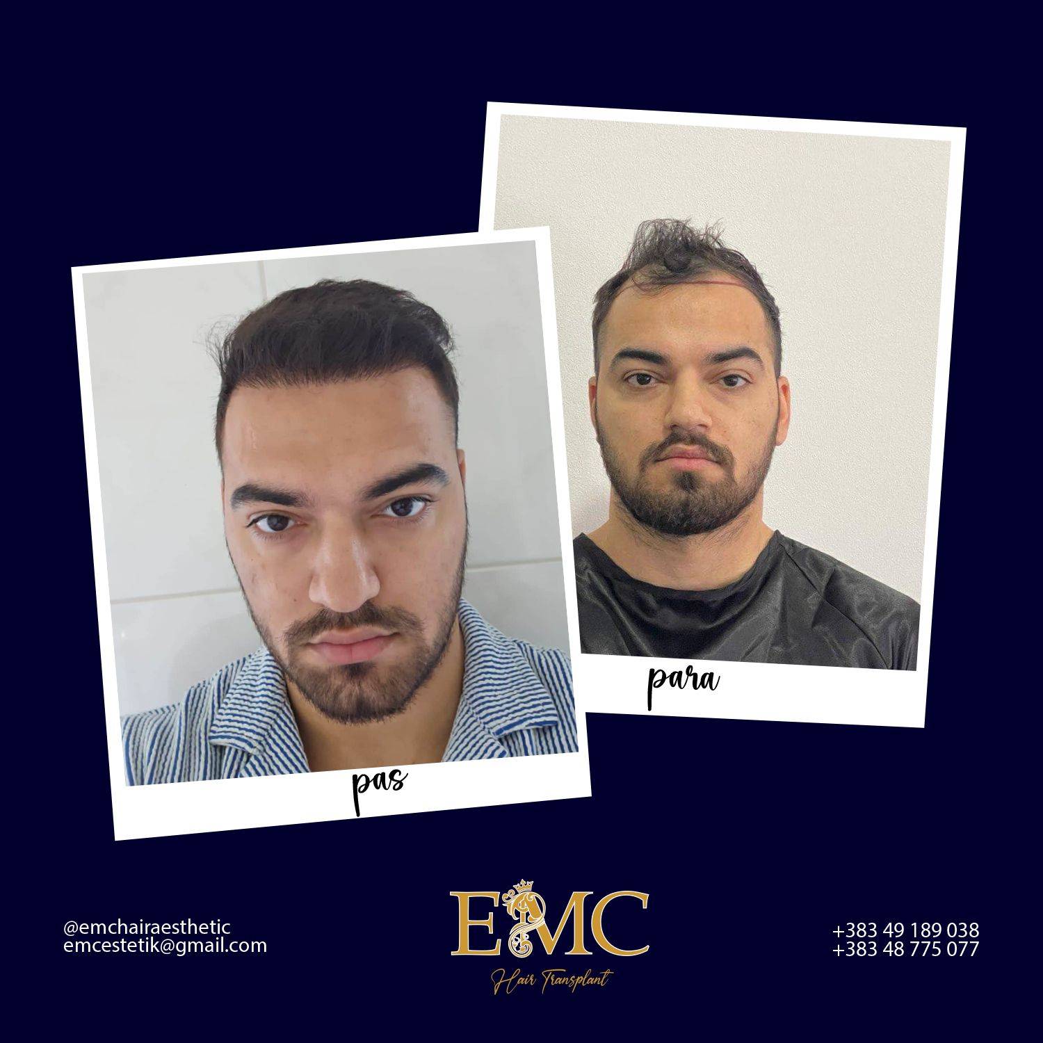 Before & After Hair Transplant Result 1