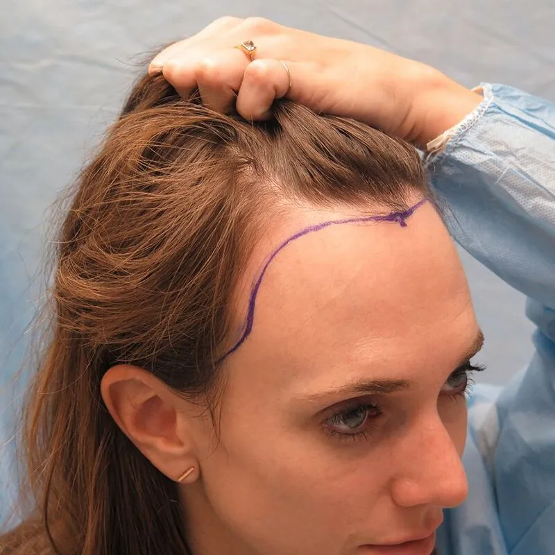 Women Hair Transplantation